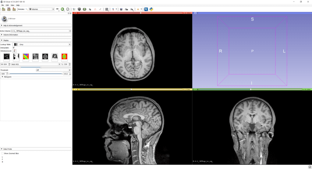 MRI data with auto W/L in 3D Slicer