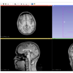 MRI data with auto W/L in 3D Slicer