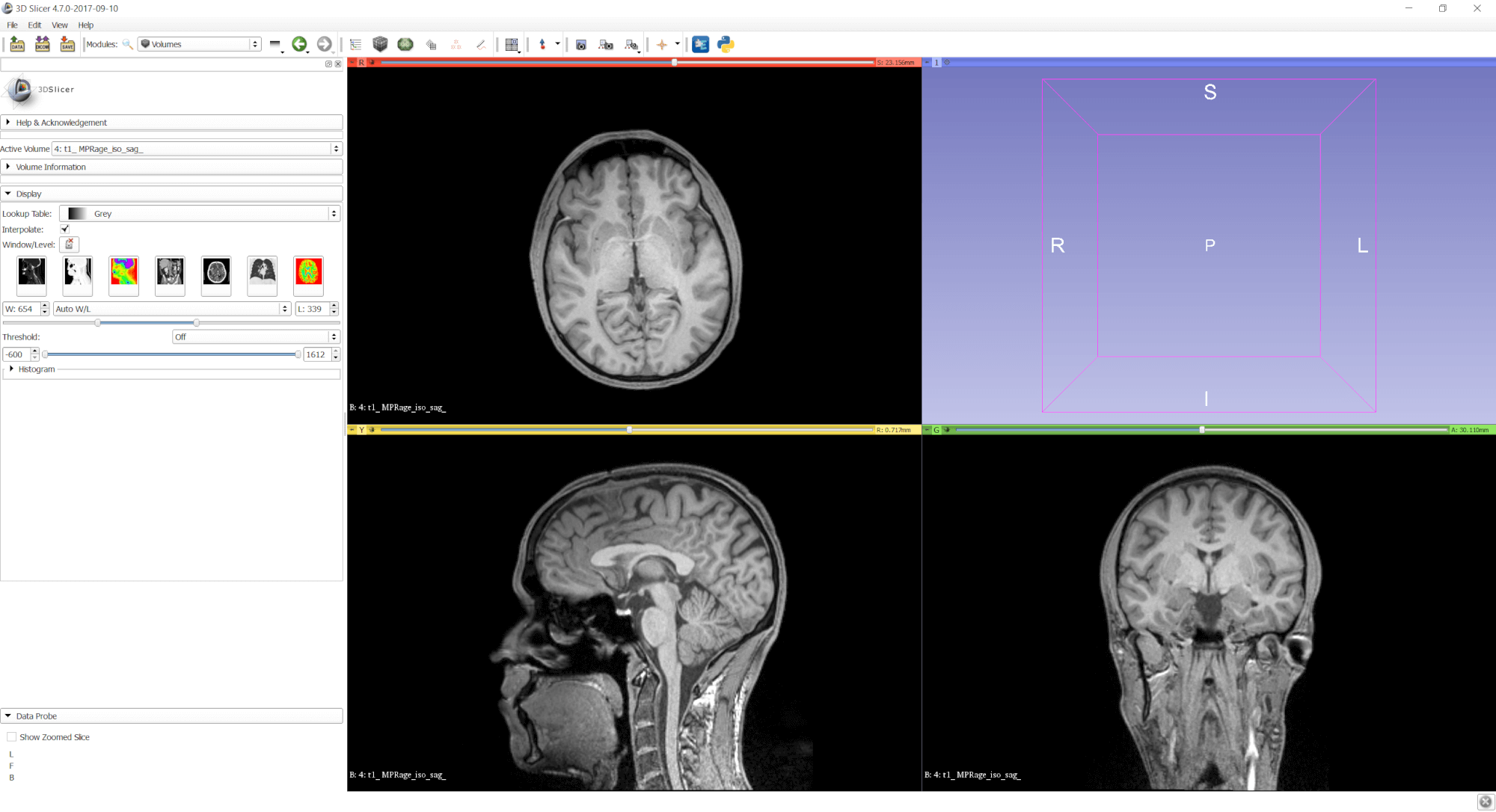 MRI data with auto W/L in 3D Slicer