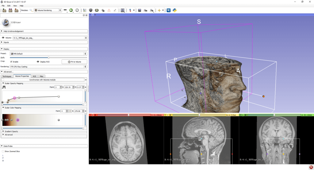 Region of Interest in a 3D Volume Rendering of an MRI in 3D Slicer