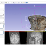 Region of Interest in a 3D Volume Rendering of an MRI in 3D Slicer