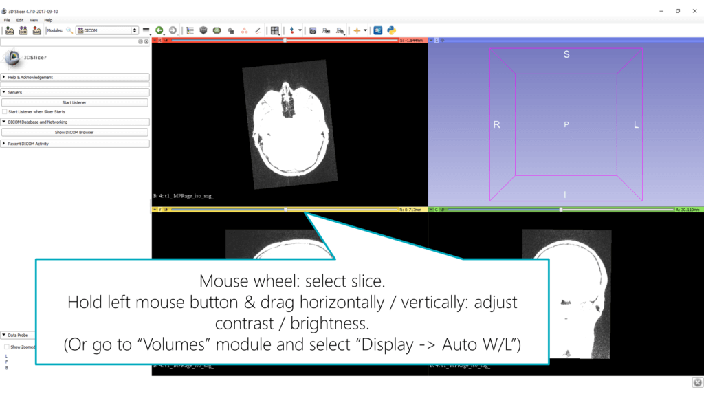 DICOM MRI scan in 3D Slicer before optimizing brightness and contrast