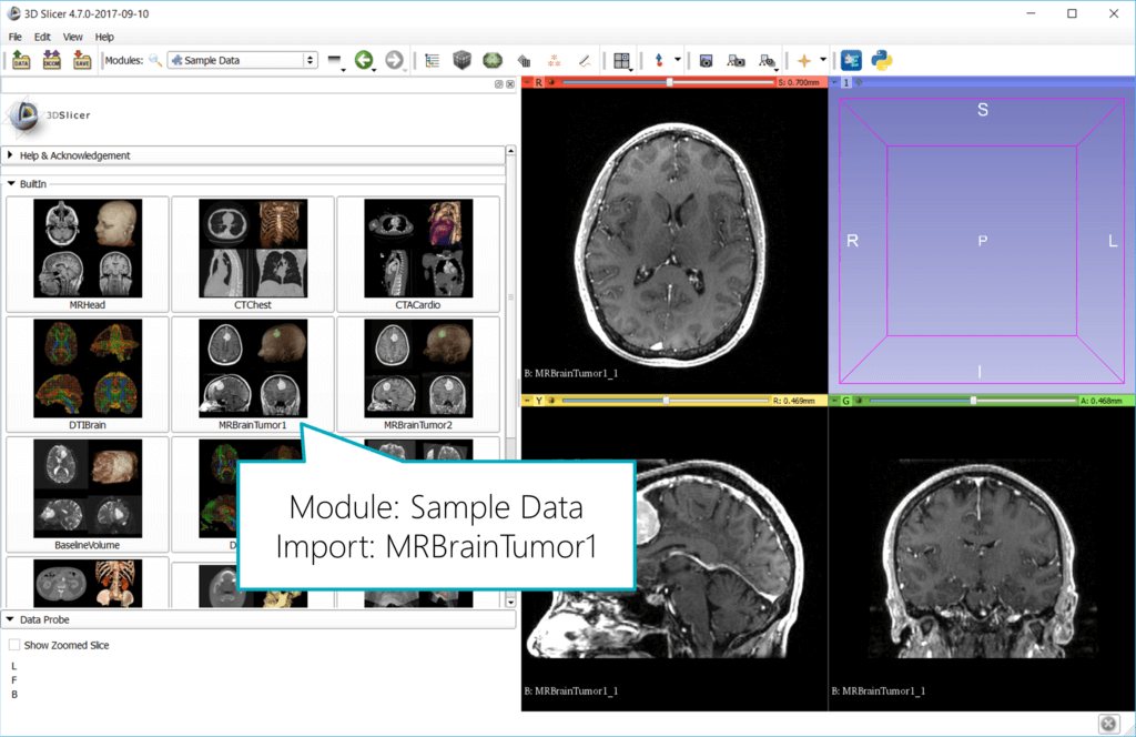 Import sample MRI data into 3D Slicer